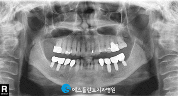 편안한 식사를 위한 어금니임플란트, 에스플란트치과에서 안전하게 진행하세요. 관련 이미지 5