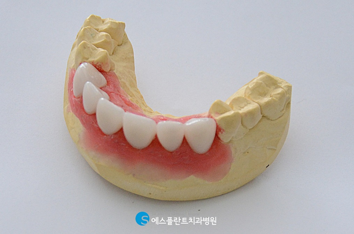 임플란트/틀니 건강보험 적용 가능합니다. 관련 이미지 4