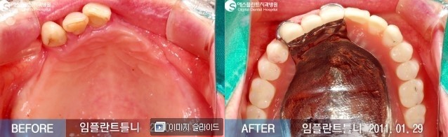 [임플란트후기] 뼈이식 임플란트, 임플란트 틀니 전/후 Story 임플란트 CASE 관련 이미지 4