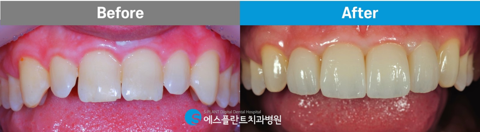 압구정치과 전치부 심미보철 수복 잘하는 에스플란트치과병원 관련 이미지 7