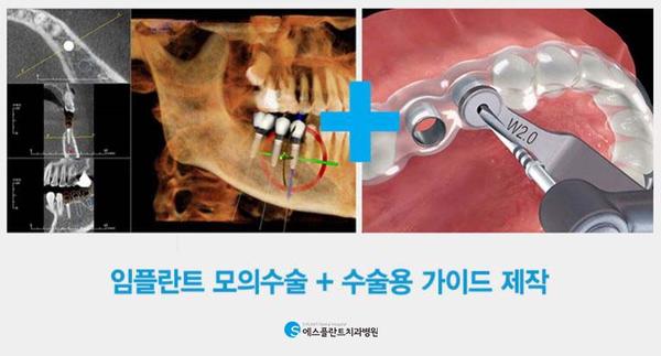 골다공증 있다면,임플란트 시술전 체크사항 관련 이미지 4