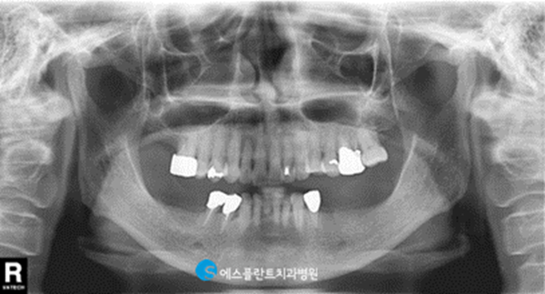 편안한 식사를 위한 어금니임플란트, 에스플란트치과에서 안전하게 진행하세요. 관련 이미지 2