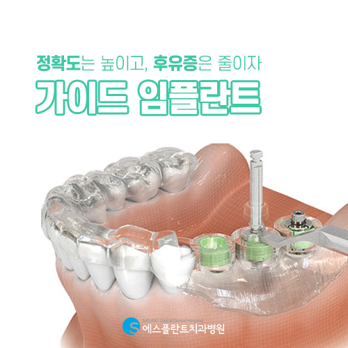 정확한 길을 찾아 안전하게 식립하는 가이드 임플란트 [에스플란트 치과병원] 관련 이미지 3