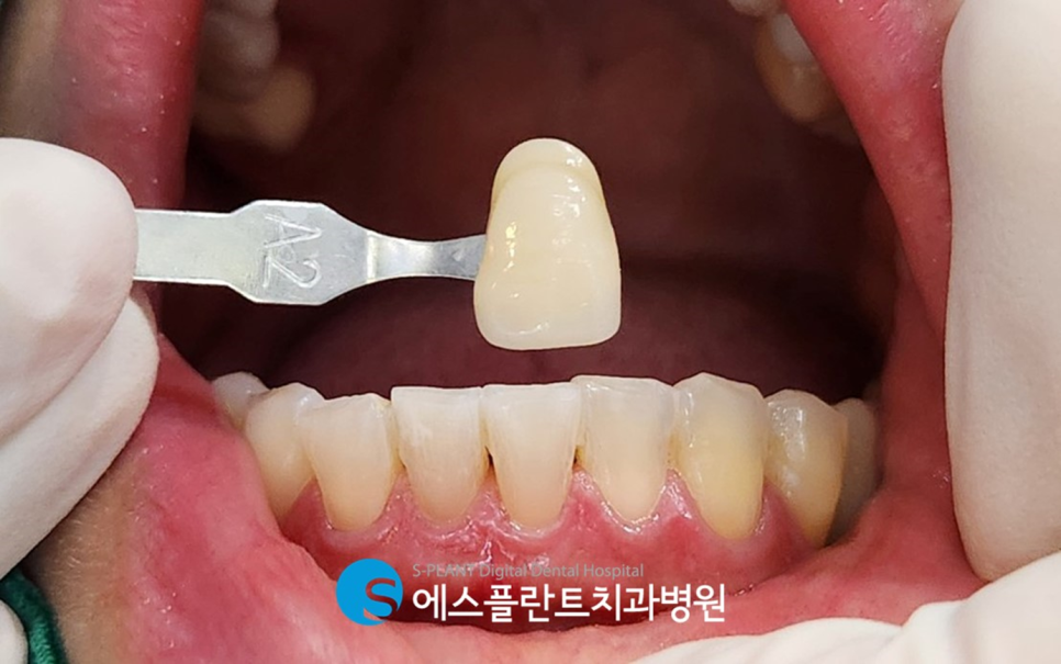 누런 치아로 고민이라면?! 에스플란트치과병원 원데이 강남 전문가 치아미백으로 하얗게 관련 이미지 4