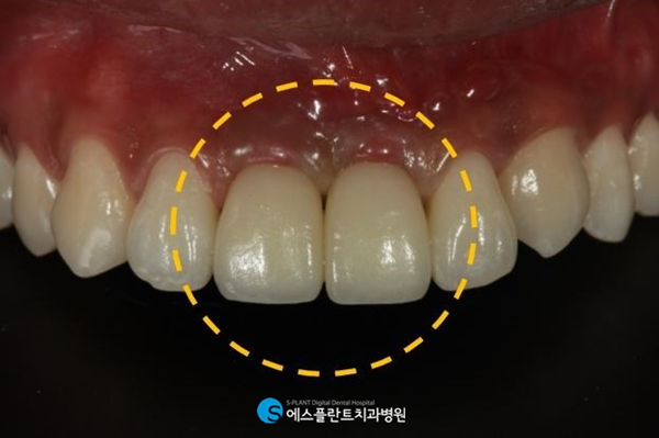 사고로 파절 된 앞니! 에스플란트치과에서 앞니임플란트로 심미성을 회복하세요! 관련 이미지 6