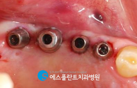 저작기능의 핵심, 어금니 임플란트 식립에는 압구정 에스플란트 치과병원의 가이드 임플란트 관련 이미지 9