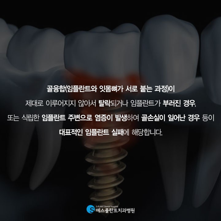 임플란트 재수술, 일반수술과 다른점은? 관련 이미지 4