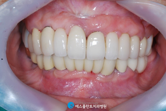 틀니가 헐겁고 불편하다면? 전악임플란트하세요.<에스플란트치과병원> 관련 이미지 6