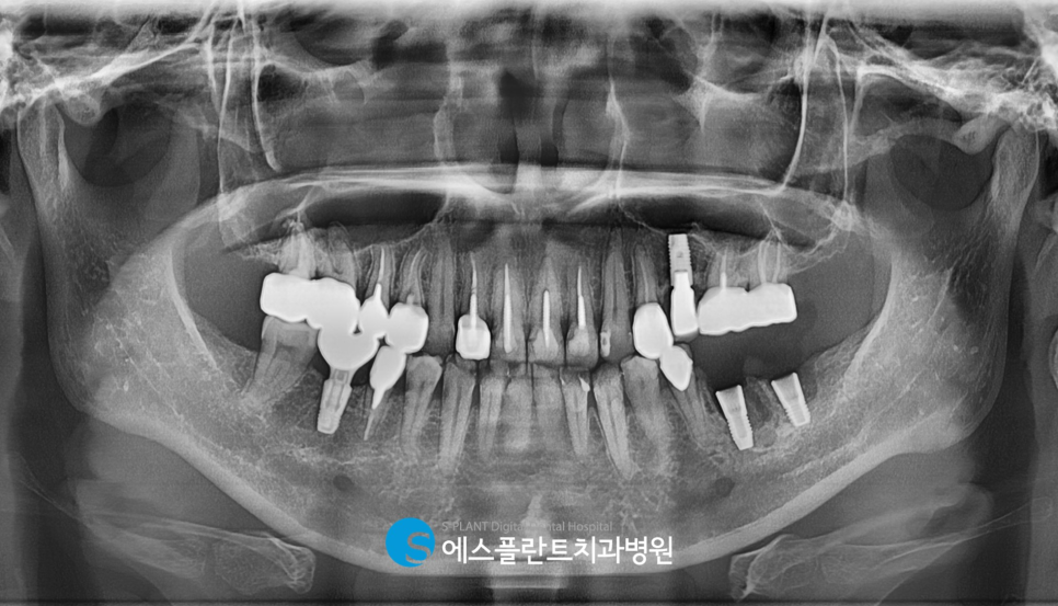 강남 압구정로데오 임플란트 잘하는 치과 에스플란트치과의 골이식을 동반한 어금니 발치 후 즉시 식립 임플란트 (아스트라 임플란트) 관련 이미지 5