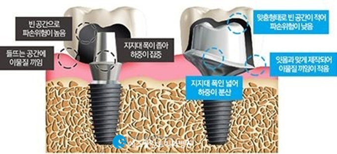 빠른 치료가 가능한 당일임플란트 관련 이미지 4