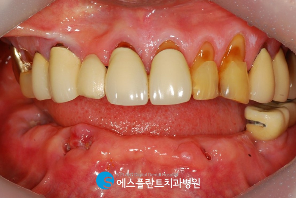 하악 다수 임플란트 식립 시에는 청담 임플란트 잘하는 치과, 에스플란트치과에서 관련 이미지 3