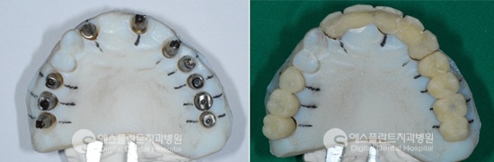 전체임플란트, 당일 임플란트 시술과정 관련 이미지 7