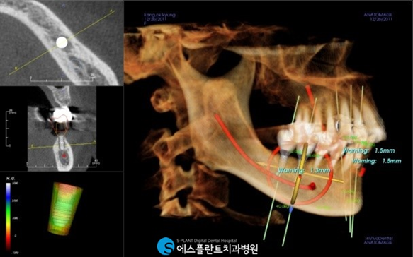뼈이식임플란트 이렇게 진행됩니다. 관련 이미지 4