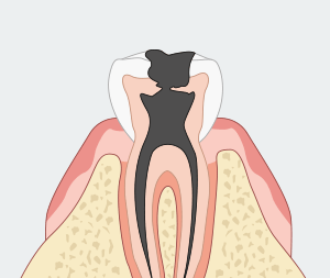 자연치아를 최대한 보존하기 위한 신경치료 [에스플란트 치과병원] 관련 이미지 3