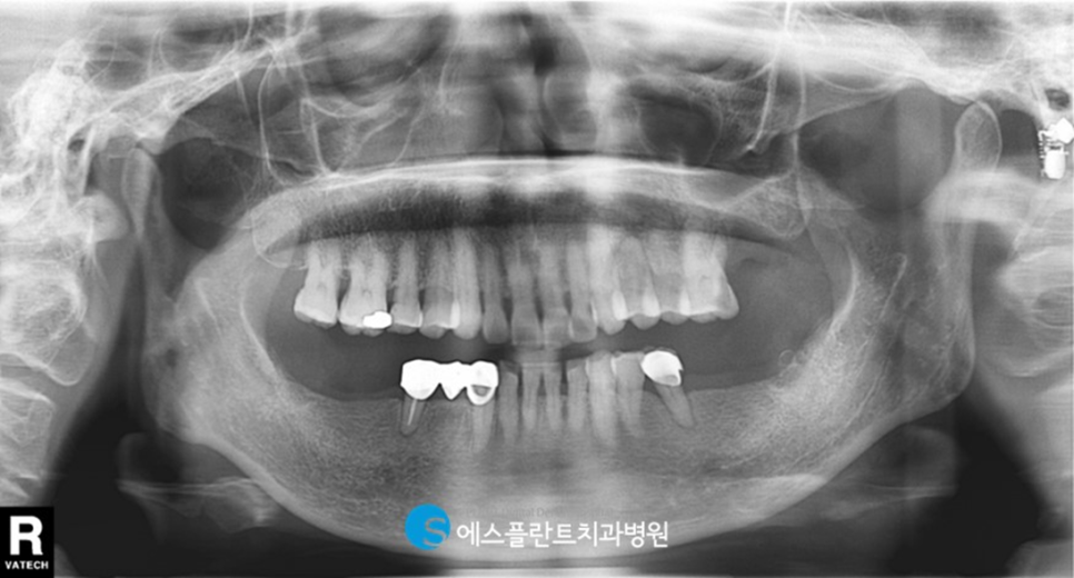 하악 임플란트 잘하는 치과, 강남 에스플란트 치과병원에서 어금니 저작기능 회복 관련 이미지 1