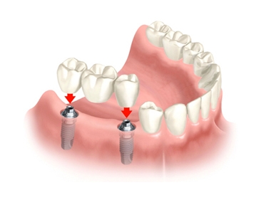 임플란트, 3D CT 가상수술 후 잇몸 최소 절개로 합병증 줄여 관련 이미지 4