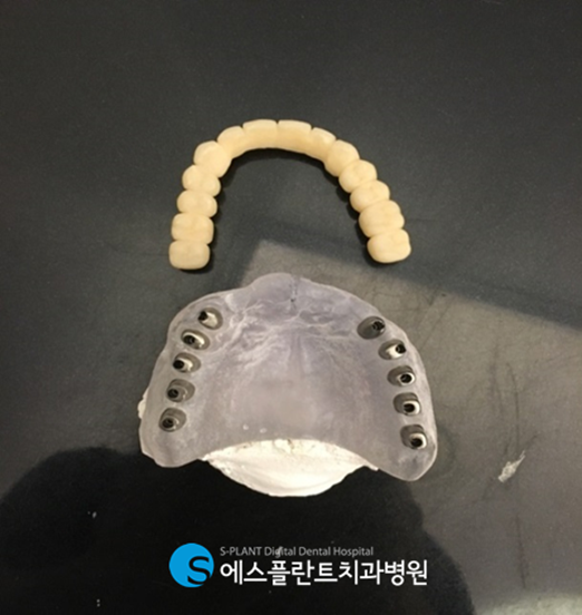 전체임플란트 이렇게 진행됩니다! 관련 이미지 3