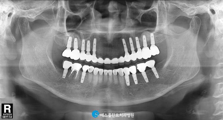 치아를 즉시 사용해야 한다면? 에스플란트치과에서 즉시기능임플란트 하세요! 관련 이미지 7