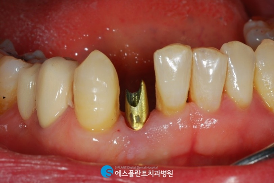 하악 전치부 치아손상, 임플란트로 심미성을 회복하세요! 관련 이미지 5