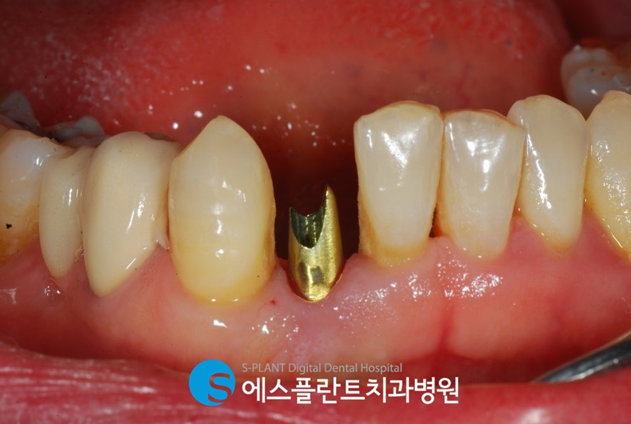 웃을 때 잘 보이는 전치부!하악 전치부 임플란트 치료 사례입니다. 관련 이미지 3