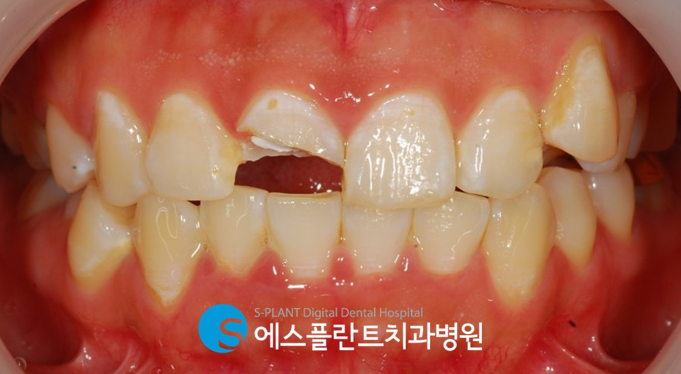 강남 부러진 앞니 임플란트 잘하는 치과, 에스플란트치과병원(전치부 발치 즉시 임플란트 및 당일 임시치아 세팅) 관련 이미지 1