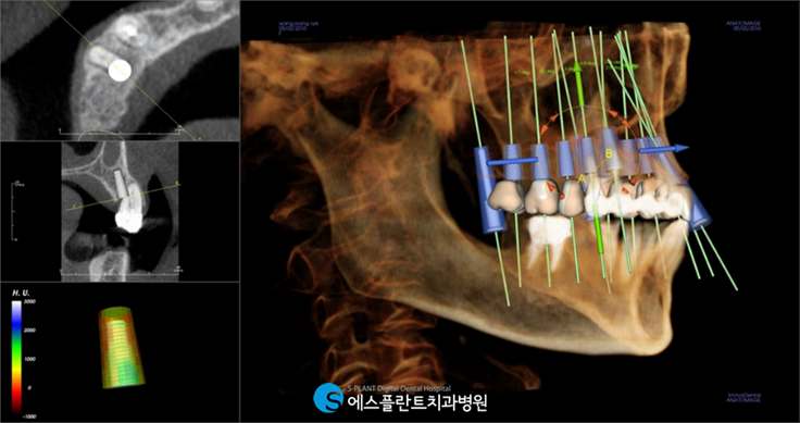 치아를 즉시 사용해야 한다면? 에스플란트치과에서 즉시기능임플란트 하세요! 관련 이미지 3