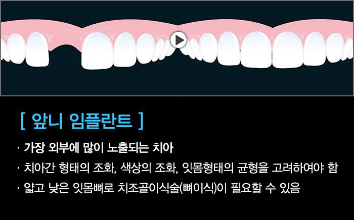 앞니깨짐 발생하면 심미성을 고려한 임플란트로 선택하세요 관련 이미지 2