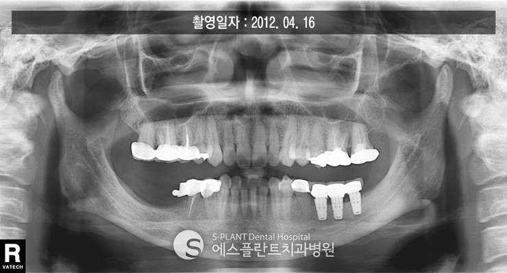 하악 어금니 임플란트뼈이식 관련 이미지 4