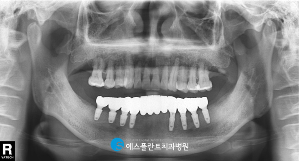 하악 무치악 임플란트 수술 고민이라면?! 청담 임플란트 잘하는 치과 에스플란트 치과병원에서 관련 이미지 6