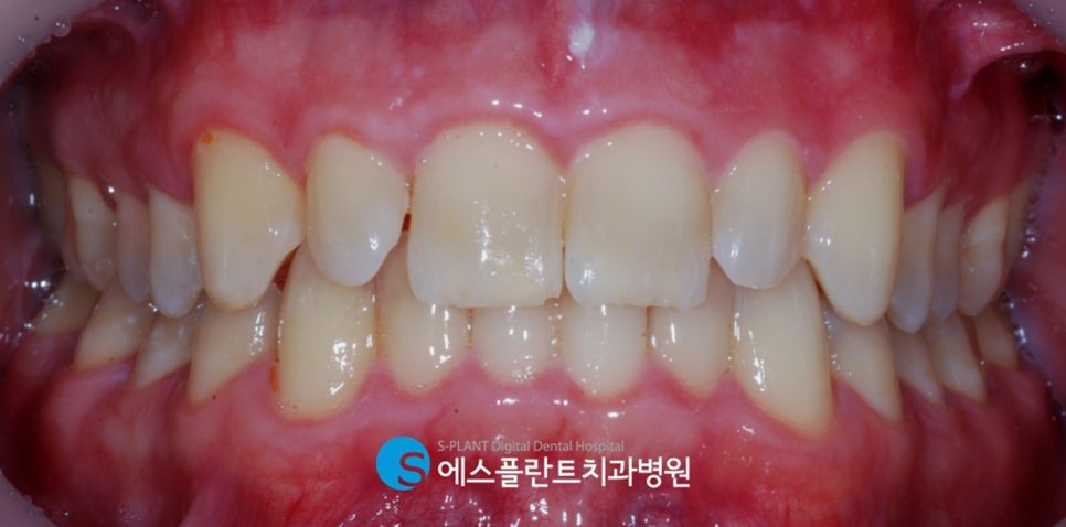 압구정치과 전치부 심미보철 수복 잘하는 에스플란트치과병원 관련 이미지 2