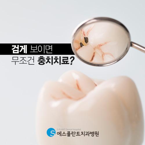 올바른 관리로 천천히 가능한 충치치료 관련 이미지 1