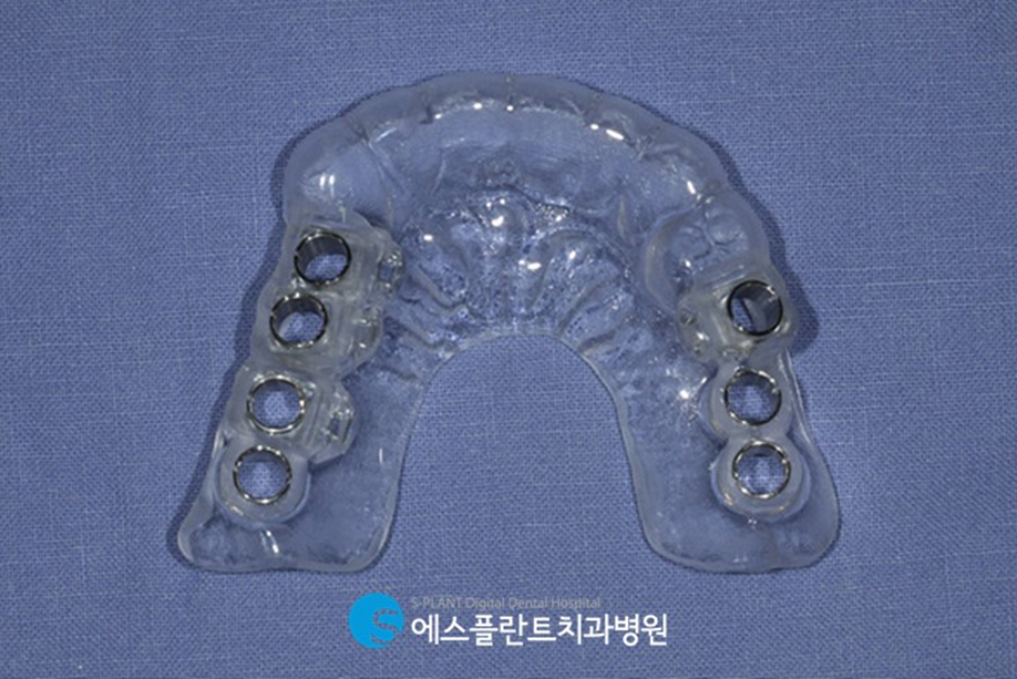압구정로데오역치과 임플란트 잘하는 치과, 에스플란트 치과병원에서 실제로 사용하는 가이드 임플란트란?! 관련 이미지 5