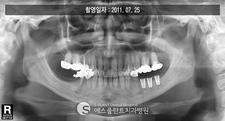하악 어금니 임플란트뼈이식 관련 이미지 3