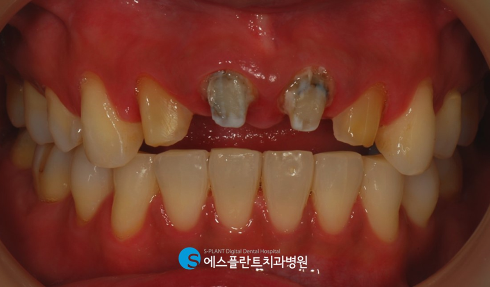 압구정로데오 앞니 벌어짐 정중이개 치료 잘하는 치과, 에스플란트치과병원의 전치부 심미보철 관련 이미지 4