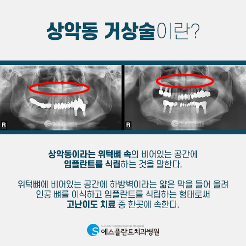 어금니 임플란트 하러 갔는데, 상악동 거상술 하는 이유 [에스플란트 치과병원] 관련 이미지 4