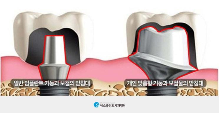 튼튼함이중요한어금니임플란트 관련 이미지 7