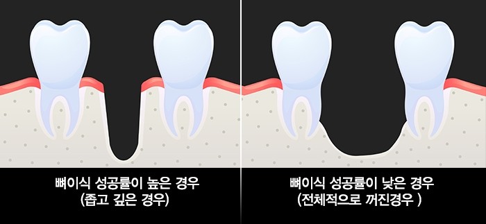 임플란트 시술시 중요포인트 꼭 확인하세요. 관련 이미지 6