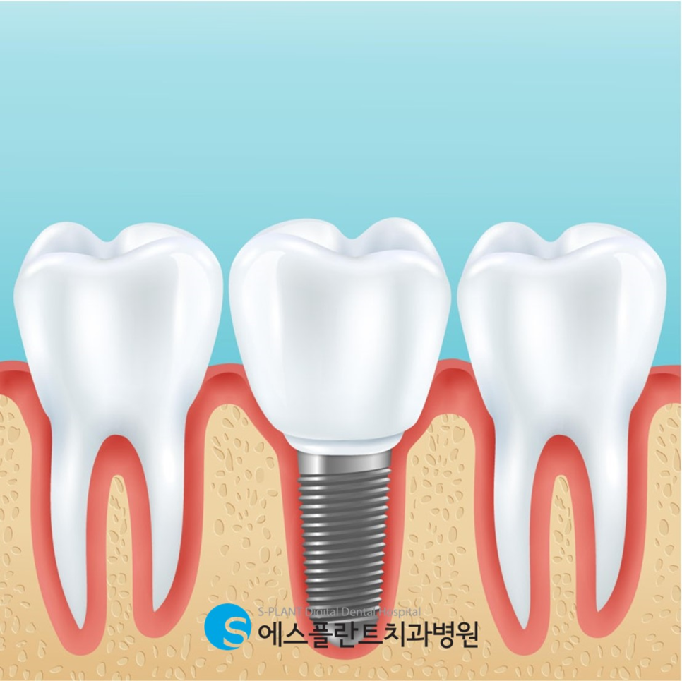 Apgujeong Implant Dental Clinic: What Should Be Considered Before Implant Placement?! image 2