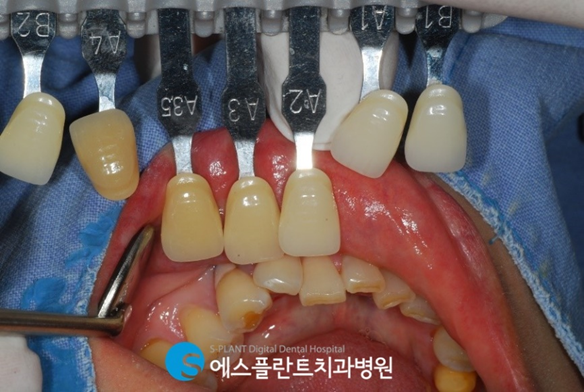 바쁜 현대인을 위한 즉시기능임플란트! 관련 이미지 4
