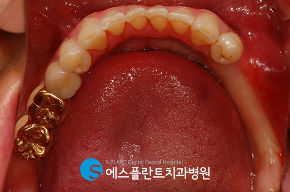 골이식을 동반한 고난이도 임플란트 시술 잘하는 치과, 에스플란트치과병원 관련 이미지 3