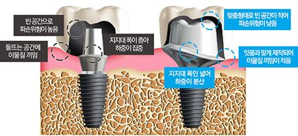 첫 식립보다 더 어려운 임플란트 재수술도 에스플란트 치과병원에서 관련 이미지 5