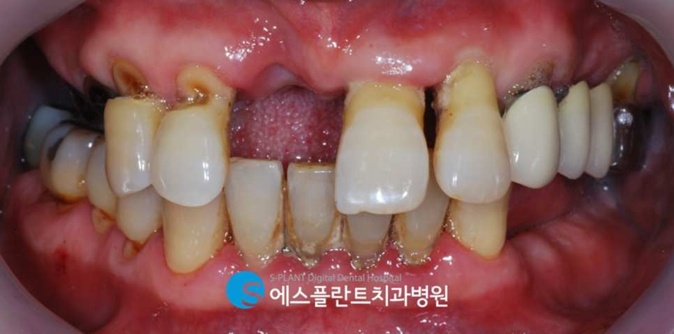 압구정 임플란트, 에스플란트치과병원의 편안하고 정확한 식립이 가능한 전악 가이드 임플란트 관련 이미지 1