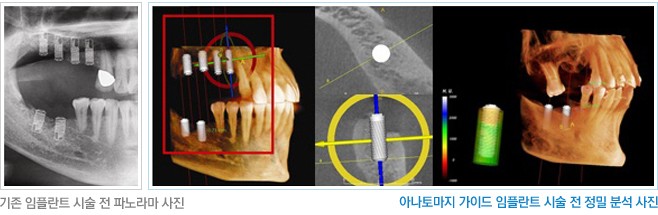 [임플란트잘하는치과] 노인임플란트, 아나토마지 가이드를 이용한 당뇨 환자 임플란트 관련 이미지 1