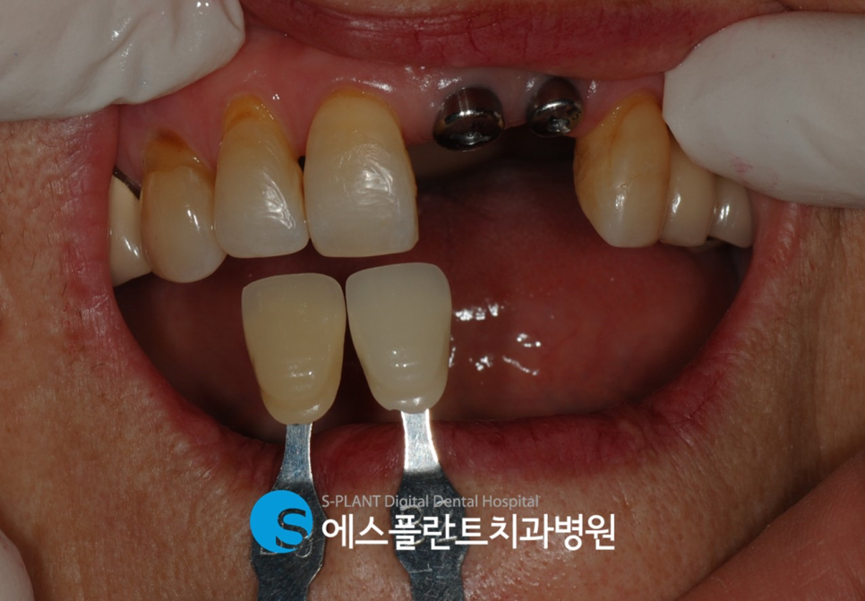 압구정 임플란트 잘하는 치과, 앞니 치관치근 파절 인한 임플란트 수술이 가능한 에스플란트치과병원 관련 이미지 4