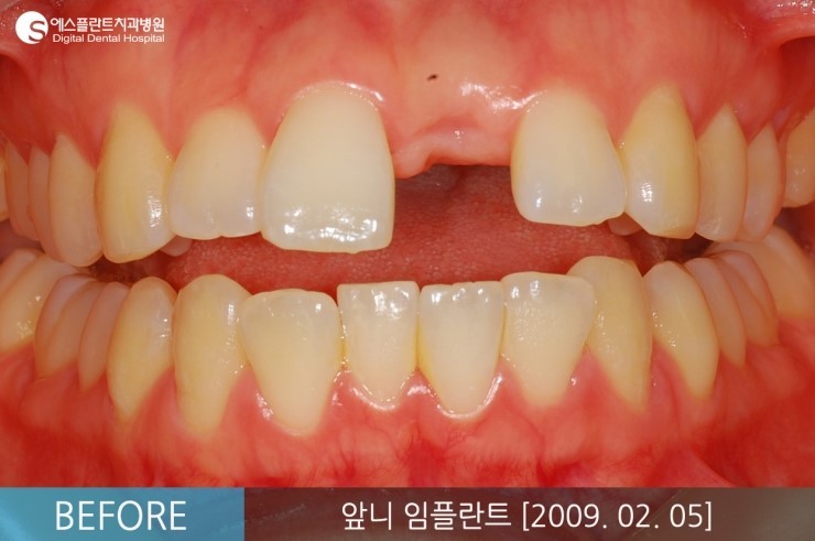 [뼈이식임플란트] 앞니 임플란트, 뼈이식 앞니 임플란트 전후 CASE 관련 이미지 2
