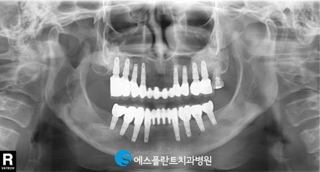 치아를 모두 상실했다면?전악임플란트로 자연치아와 같은 저작력을 되찾으세요! 관련 이미지 5