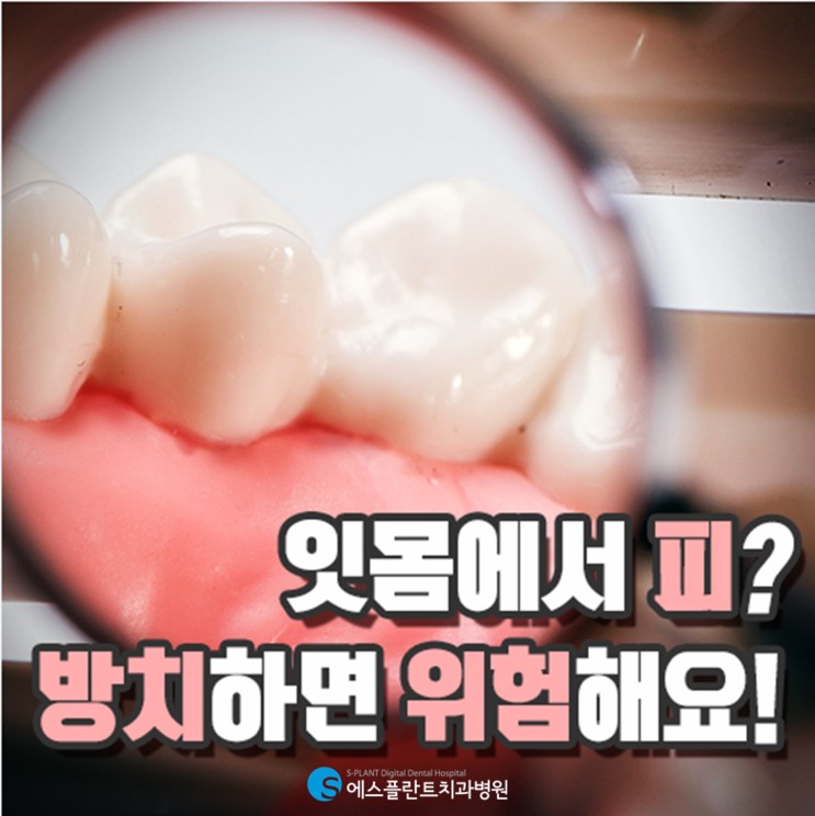 잇몸에서 피? 방치하면 위험해요! 관련 이미지 1