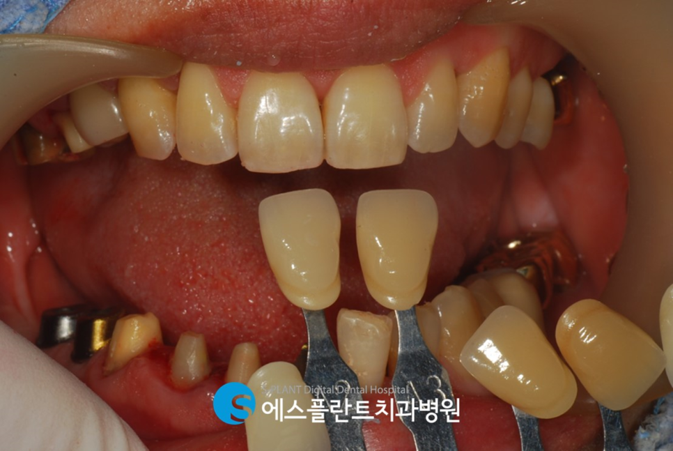 하악 대구치 임플란트 시 가이드 임플란트가 필요한 이유?! 하치조 신경 손상 피해 에스플란트 치과병원에서 정확하고 안전하게 관련 이미지 6