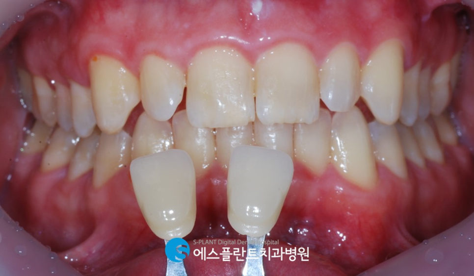 압구정치과 전치부 심미보철 수복 잘하는 에스플란트치과병원 관련 이미지 5