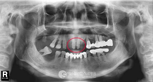다수의 임플란트 식립도 에스플란트를 믿고 진행하신 환자분의 사례 관련 이미지 1
